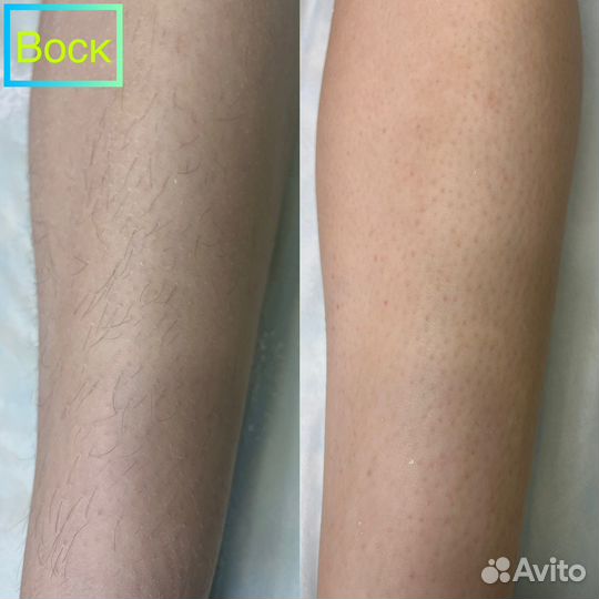 Депиляция женская