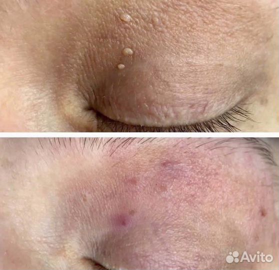 Удаление папиллом