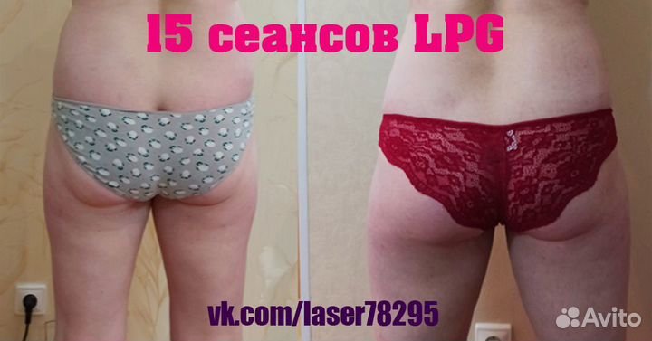 LPG массаж Славянка, Пушкин антицеллюлитный массаж