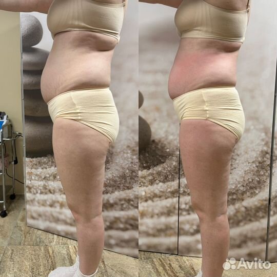 LPG лпг массаж