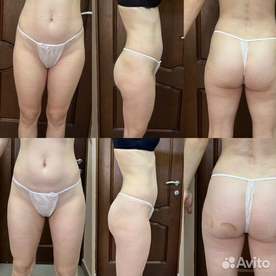 Антицеллюлитный массаж, коррекция фигуры