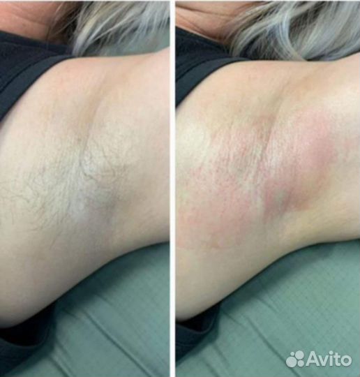 Электроэпиляция