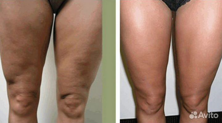 LPG массаж. Кавитация. Прессотерапия. RF лифтинг