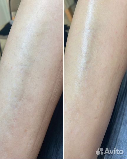 Восковая депиляция