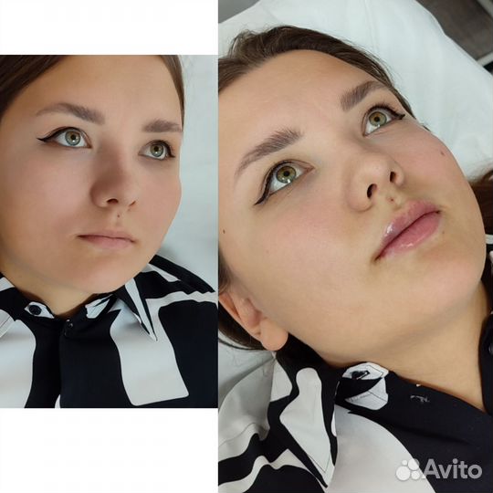 Контурная пластика губ