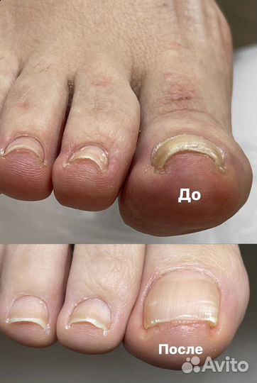 Педикюр медицинский, эстетический.Подология