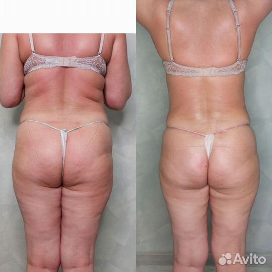 Аппаратный массаж, аппаратная коррекция фигуры