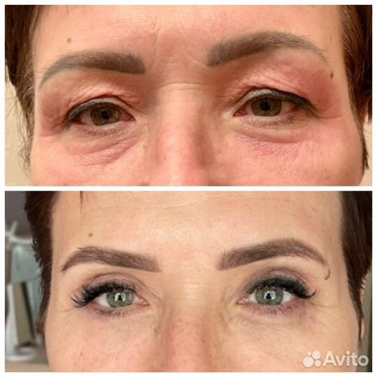 Холодная плазма.Омоложение