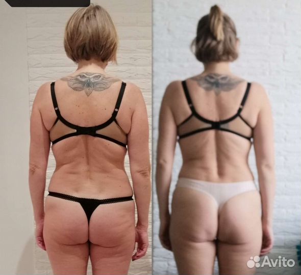 Антицеллютный массаж. Нолар. Массаж для похудения