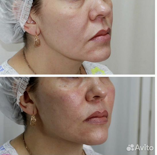 Коррекция нижней трети лица