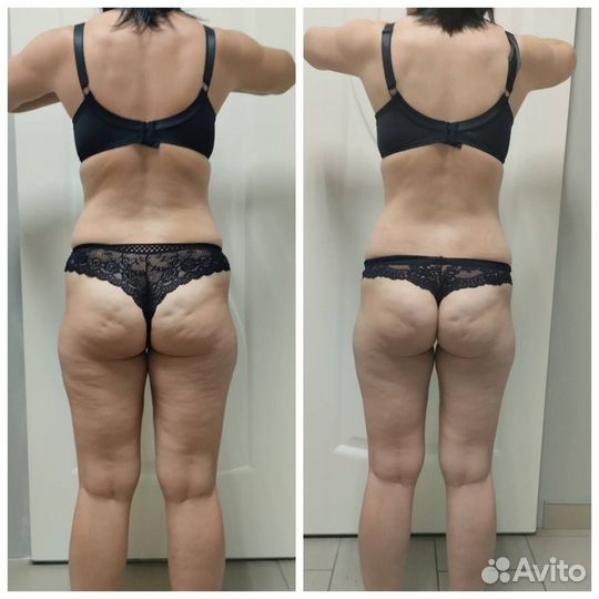 Аппаратный массаж