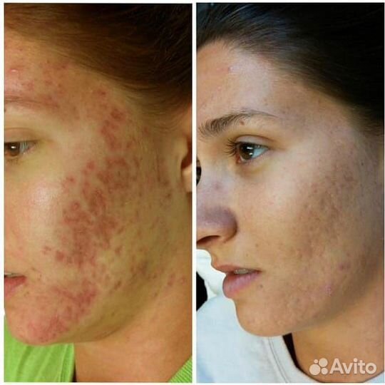 LPG массаж симферополь