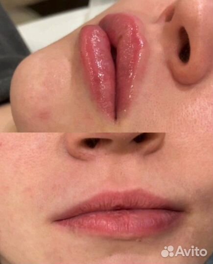 Увеличение губ