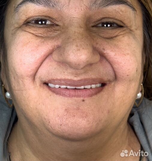 Зубные протезы