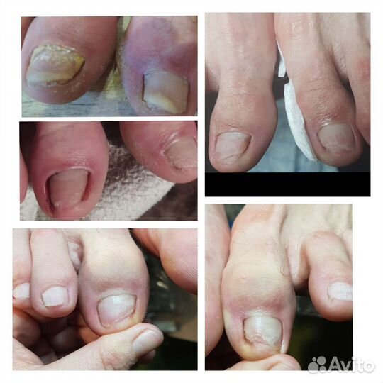 Подолог. Педикюр.лечебный педикюр. Сложные стопы