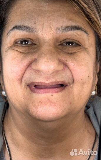 Зубные протезы