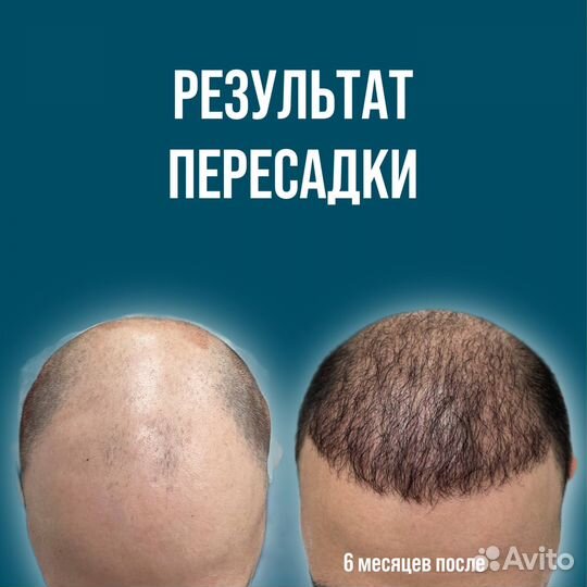 Пересадка волос