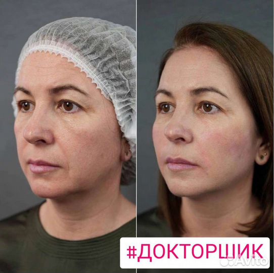 Контурная пластика