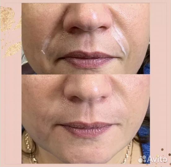 Услуги косметолога уколы красоты