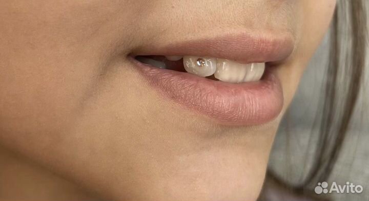 Установка скайсов