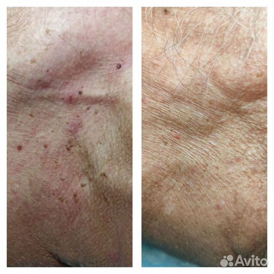 Удаление папиллом, бородавок жидким азотом