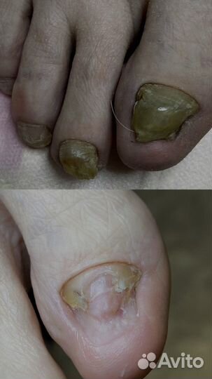 Подолог, установка титановой нити