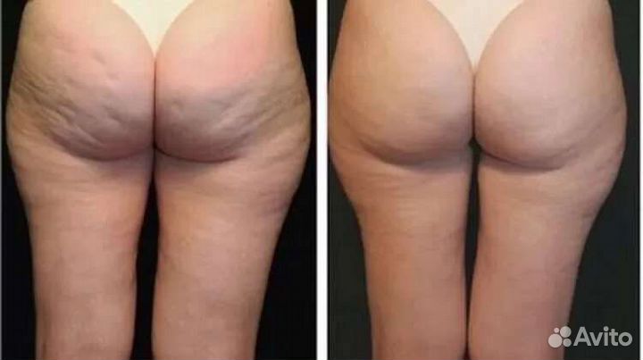 Антицеллюлитный массаж тела