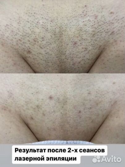 Лазерная эпиляция