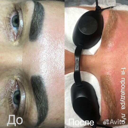 Удаление татуажа