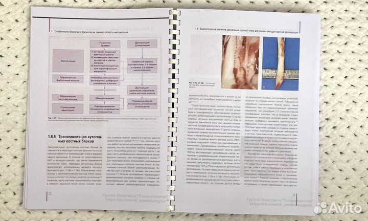 Регенеративные методы в имплантологии