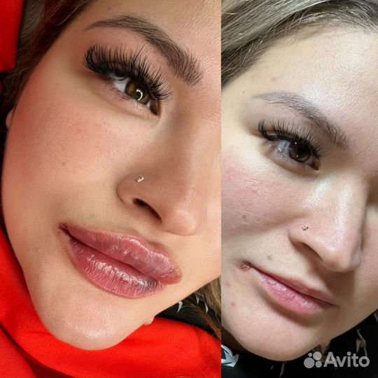 Косметолог Увеличение губ Контурная Fullface