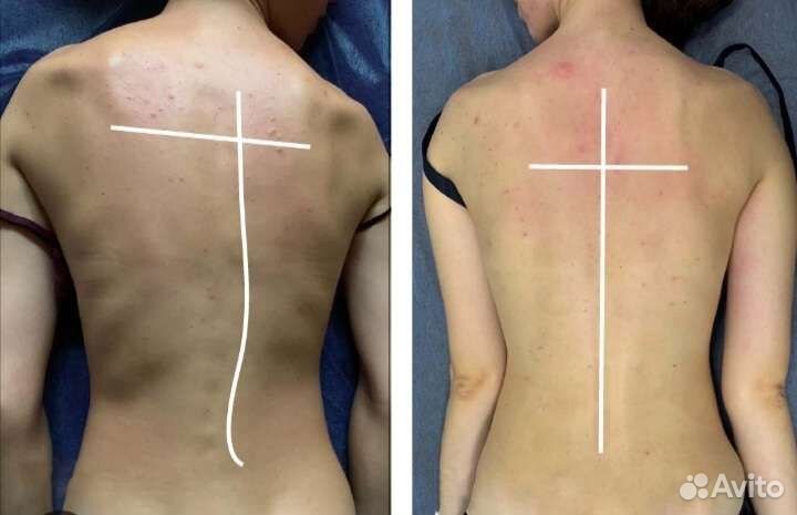 Лечебный массаж спины