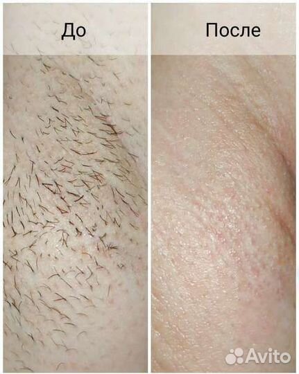 Шугаринг Мужской и Женский