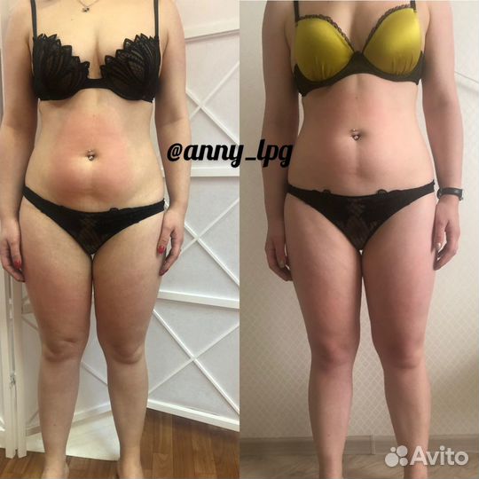 Антицеллюлитный массаж