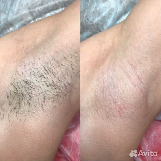 Шугаринг Воск чмр