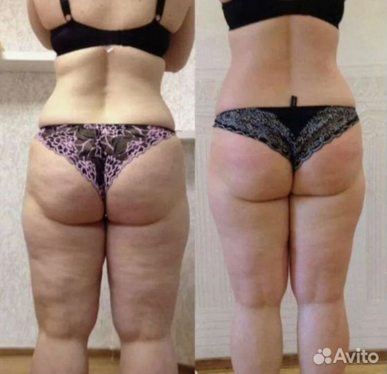 LPG идеальное тело- легко