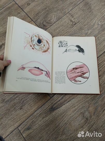 Атлас Внутриглазные опухоли