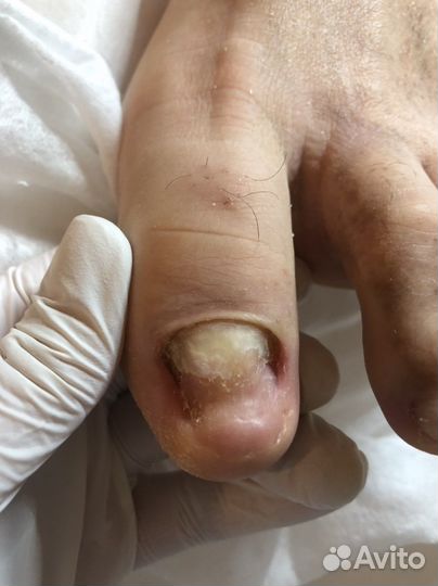 Педикюр Подология