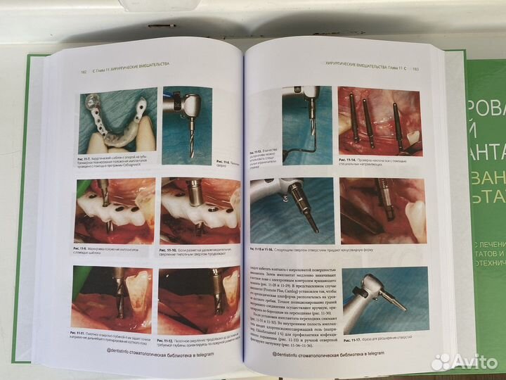 Протезирование с опорой на имплантаты