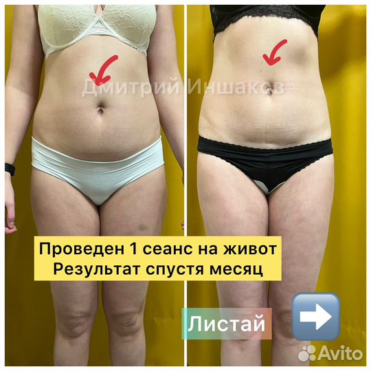 Лимфодренажный массаж