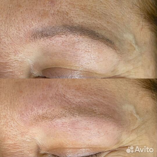 Удаление татуажа лазером