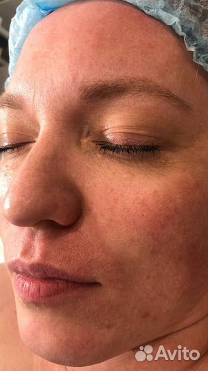 Чистка лица глубокий пилинг в подарок