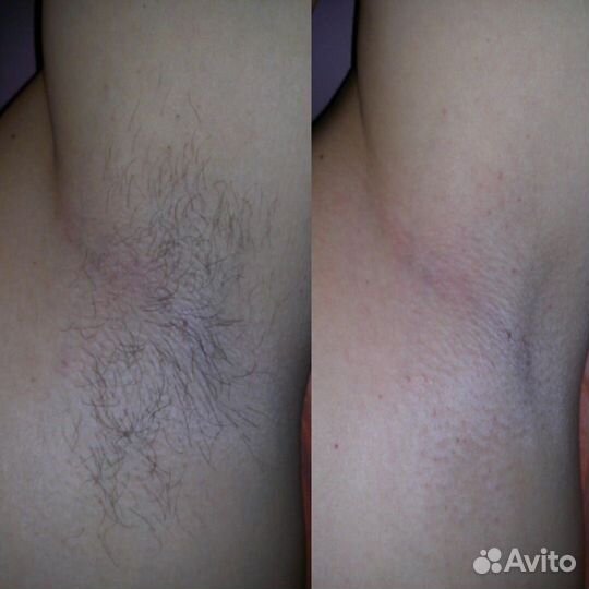 Спа-шугаринг