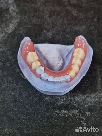 Изготовление съёмных,бюгельных протезов