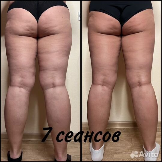 Антицеллюлитный массаж