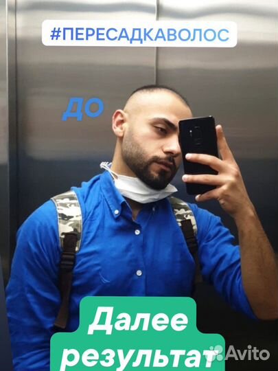 Пересадка волос