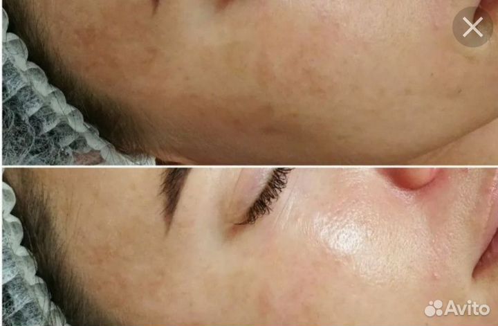 Карбоновый пилинг аппарат