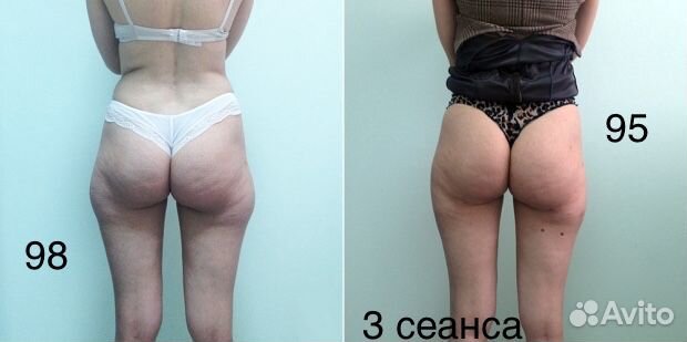 Армопластика