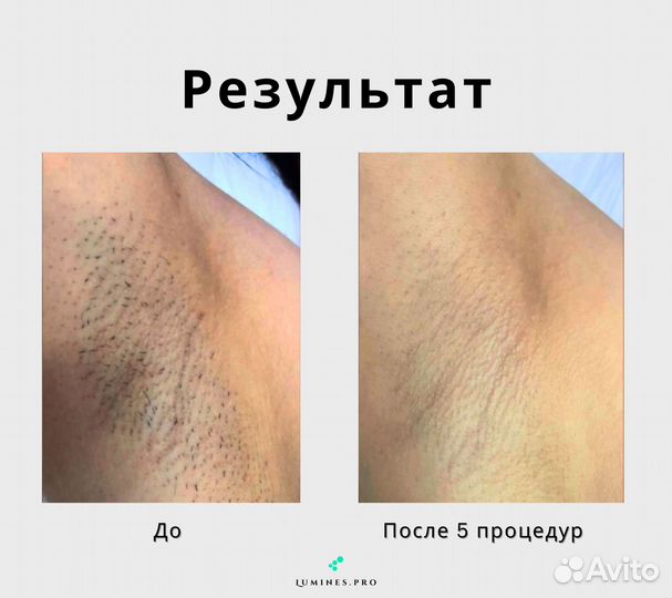 Диодный лазер для эпиляции Люминес. MaxOne 1200в