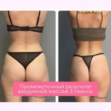 Коррекция фигуры/ вакуум